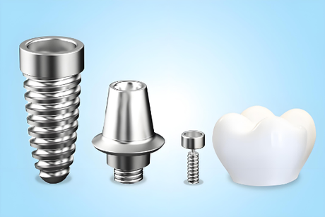 Titanium dental implants Titanium dental implants